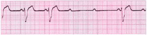 ACLS ECG Rhythm Strips Pretest Question Answers (Quiz) PDF