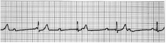 ACLS Rhythms Practice Test 2020 Recognition Rhythm Strips [PDF]