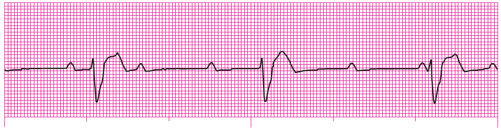 ACLS Precourse Self Assessment Answers Pharmacology Rhythm acls-precourse-self-assessment-answers-pharmacology-rhythm