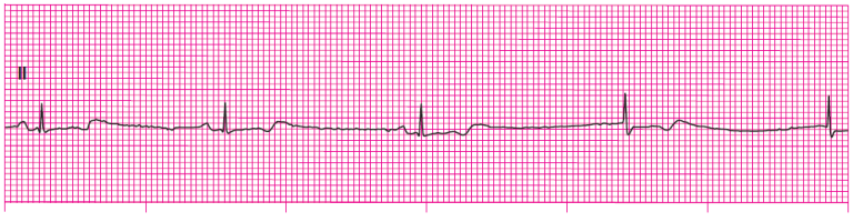 ACLS Precourse Self Assessment Answers (Pharmacology, Rhythm)