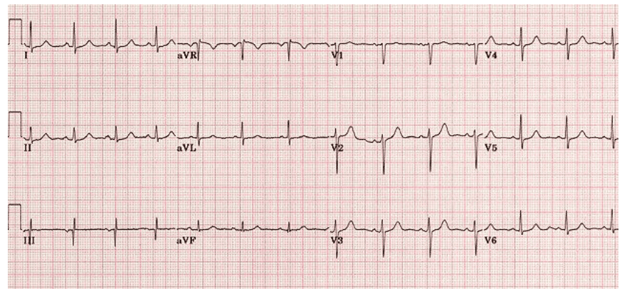 EKG Rhythm Strips Practice Test 2023 - GoTestPrep.com